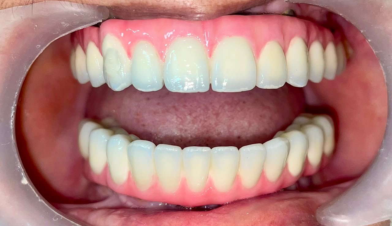Final Completed Smile Dental Implants